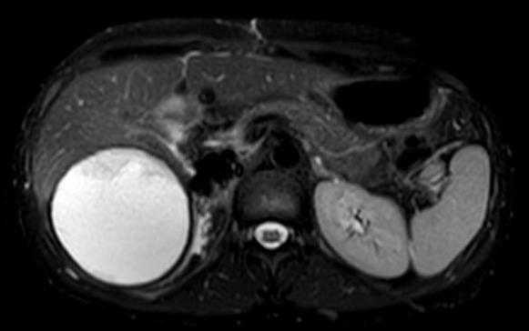 Resonancia magnética de abdomen con hiperamonemia y carcinoma fibrolamelar. 